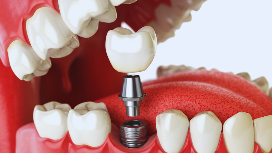 Are Dental Implants Really Worth It? Here’s What You Need to Know